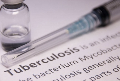 India accounts for 26 pc of global TB burden, the highest — WHO
